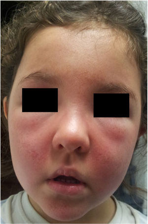Erythematous, scaly plaques and edema on the face, trunk, and skinfolds after exposure to sunlight.