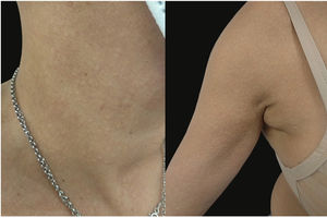 a, b) Pápulas delgadas y agrupadas con apariencia de empedrado en la parte lateral del cuello y la axila, semejantes al pseudoxantoma elástico.