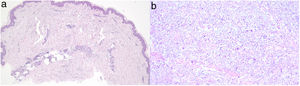 a) Infiltrado dérmico intersticial superficial y profundo con histiocitos e infiltrado linfocitario perivascular (hematoxilina y eosina 40×). b) Depósitos de mucina observados con tinción de azul alcián (hematoxilina y eosina 60×).