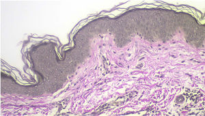 La tinción de Verhoeff-Van Gieson muestra fibras elásticas de oxitalán conservadas en la dermis papilar y reticular.