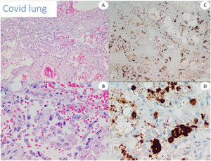 Necropsia pulmonar de un paciente con COVID-19. Visión hematoxilina-eosina (HE) izquierda. Inmunohistoquímica derecha con anticuerpo anti-spike 3.