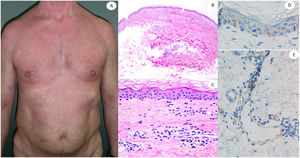 Reacción maculopapular en una mujer de 53 años afectando el tronco y las extremidades. La imagen histopatológica muestra una epidermis aplanada normal, así como infiltrado perivascular linfocítico escaso. La inmunohistoquímica de anti-spike 3 muestra tinción granular principalmente localizada en la epidermis y los endotelios, pero también entremezclada dentro del infiltrado inflamatorio.