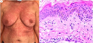 Reacción urticariforme en una mujer de 62 años, que refleja infiltrado inflamatorio perivascular escaso con células polimorfonucleares (PMN) y pocos eosinófilos, degeneración vacuolar, PMN epiteliotrópicas y pocos queratinocitos apoptóticos. Las lesiones aparecieron en el domicilio, tras el alta hospitalaria del paciente con neumonía con COVID-19.