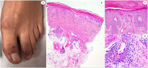 Placas purpúricas en los pies de un varón de 42 años. La histopatología muestra infiltrados inflamatorios linfocíticos densos, adyacentes a vasos y estructuras anexiales. Se observa extravasación de glóbulos rojos en la papila dérmica, así como signos claros de endotelitis.