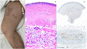 Varón de 60, en la Unidad de Cuidados Intensivos debido a neumonía bilateral por COVID-19, con lesiones reticuladas en ambas piernas. Histopatológicamente muestra necrosis de glándulas ecrinas, así como presencia de trombos de color rojo dentro de los vasos de la dermis reticular. El lado derecho muestra anti-spike 3, donde puede observarse tinción granular en una zona en la que un vaso dermohipodérmico está ocluido por un trombo rico en neutrófilos.