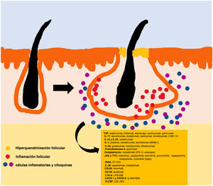 Vías inflamatorias en la hidradenitis supurativa. Fuente: elaboración propia.