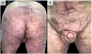 Ejemplo de hidradenitis supurativa extremadamente grave. Varón de 48 años con HS de más de 20 años de evolución, refractaria a múltiples tratamientos, incluidos adalimumab a dosis altas, infliximab y ustekinumab. Actualmente, en tratamiento con bimekizumab. Fotografías tomadas y publicadas con el consentimiento verbal y escrito del paciente. HS: hidradenitis supurativa.