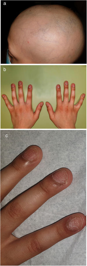 (a) Multilocular alopecia areata; (b) and (c) Fingernail pitting and trachyonychia.