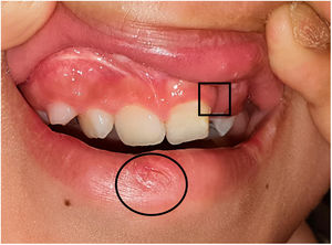 Median lower lip pit (circle) and scar from the previous surgical correction of cleft of the primary palate (square).