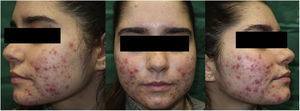 Paciente con acné nodular grave antes de comenzar el tratamiento con TFD-LD.