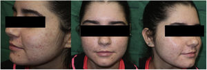 Después de cinco sesiones de TFD-LD se observó una reducción importante del acné.
