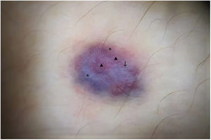 Dermatoscopia con luz polarizada: patrón multicromático global: vasos puntiformes y lineales irregulares (), líneas blanco brillantes (flecha negra) y áreas blanco-azuladas y rojizas sin estructura (*).