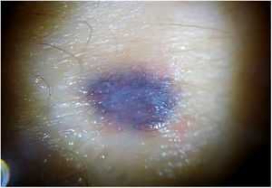 Dermatoscopia con luz no polarizada: patrón azul homogéneo.