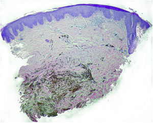 Epidermis sin cambios, melanocitos dendríticos densamente pigmentados en dermis reticular. (H-E 10x, cortesía del Dr. Carlos Martín).