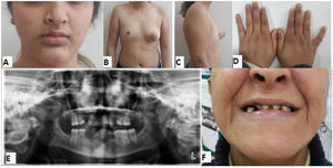 14-Year-old patient with a hypoplastic breast (the small right breast) (B, C), the small left nipple (B, C), facial paralysis (A), small hands (D), missing teeth (E), and mother
