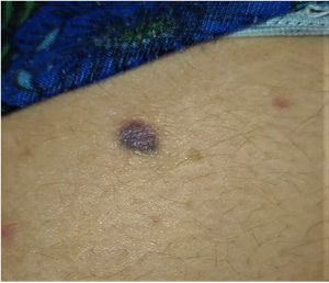 Round bluish plaque on the right buttock.