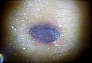 Nonpolarized dermoscopy: homogeneous blue pattern.