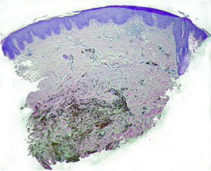 Epidermis with no changes, densely pigmented dendritic melanocytes in the reticular dermis (hematoxylin–eosin, original magnification ×10; image courtesy of Dr. Carlos Martín).