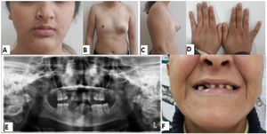 Paciente de 14 años con hipoplasia mamaria (pequeña mama derecha) (B, C), pequeño pezón izquierdo (B, C), parálisis facial (A), manos pequeñas (D), ausencia de dientes (E) y dientes de la madre (F).