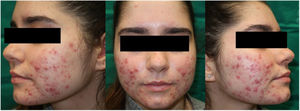 Patient with severe nodular acne before starting treatment with DL-PDT.