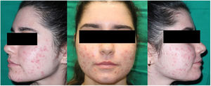 The same patient after 3 sessions of DL-PDT.