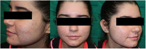 After 5 sessions of DL-PDT, a substantial decrease in acne was observed.