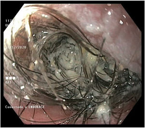 Endoscopic image of hairs growing on the hypopharyngeal flap before treatment.