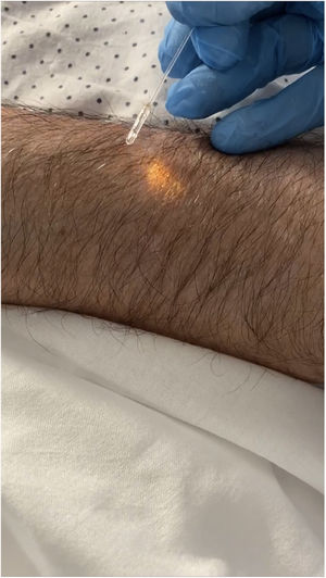 Alexandrite laser fiber with lateral light emission. Previous tests performed on patient.