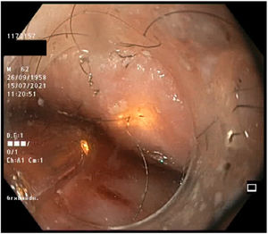 Endoscopic image of the area after treatment.