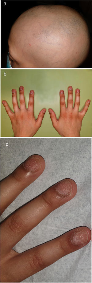 (a) Multilocular alopecia areata; (b) and (c) Fingernail pitting and trachyonychia.