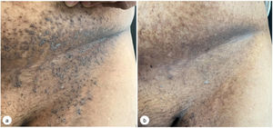 Imágenes clínicas de las lesiones de la enfermedad de Hailey-Hailey en el pliegue cutáneo abdominal inferior en la semana 0 (a) y en la semana 12 (b).