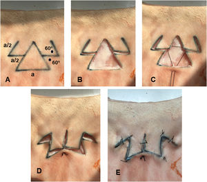 Diseño del colgajo centollo en piel de cerdo. A) Del punto central de los lados del triángulo se dibujan los dos colgajos laterales de transposición que simulan los brazos del centollo. Estos colgajos laterales medirán la mitad (a/2) de la longitud de la base del triángulo (a) y con ángulos (punto negro) de 60°. B) Extirpación del triángulo que supondrá el defecto quirúrgico y disección de ambos colgajos. C) Punto central de sutura que parte de la base del defecto triangular y pasa por los vértices internos de los colgajos laterales. D) Cierre del defecto con ese único punto central. E) Resultado final tras la sutura completa del colgajo.