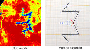 Correlación directa entre la imagen del flujo vascular con el esquema de vectores de tensión. En la imagen de la izquierda se representa el flujo vascular: el color rojo indica máxima perfusión y a medida que la vascularización disminuye la escala de colores va degradando hasta llegar al azul-negro que representa la mínima perfusión. En la imagen de la derecha están representados los vectores de tensión en cada punto, de forma que la longitud de las flechas indica la magnitud de las tensiones. El vector central señalado con 3 flechas rojas es el punto de máxima tensión y se corresponde exactamente en la imagen de flujos de la izquierda con el área central de mínimo flujo vascular de color azul-negro. La silueta de la cicatriz en «W» donde se concentran las tensiones se corresponde exactamente con la imagen de los flujos en color azul.