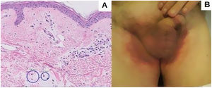 A)Infiltrado inflamatorio perivascular superficial de predominio linfocítico con algún eosinófilo (círculo). B)Eritema inguinal bilateral, bordes bien definidos, no fisuración.