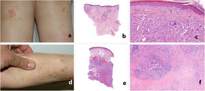 Aspecto clínico e histológico de las reacciones sarcoideas relacionadas con ICI. a-c) Sarcoidosis papulosa de las rodillas. Los granulomas están localizados predominantemente en la dermis superficial y es frecuente observar la presencia de cuerpos extraños. d-f) Sarcoidosis subcutánea. Los granulomas están prácticamente limitados al tejido celular subcutáneo, rodeados de una mayor cantidad de linfocitos e importante fibrosis.