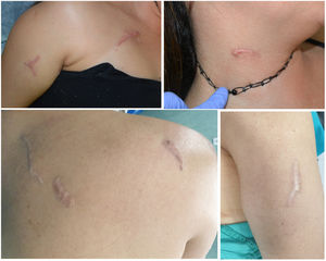 Case 1. Scars as a result of a knife attack. The upper images show localized lesions on the chest, arm, and neck prior to treatment. The lower images show lesions observed on the back and arm after treatment with pulsed dye laser and corticosteroid infiltrations.