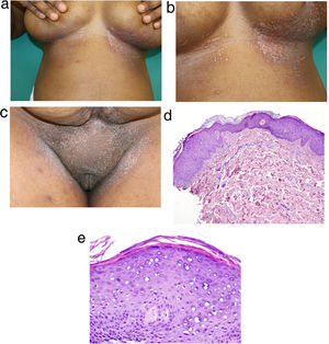 A, Flat rose-colored papules in the inframammary folds, some with a linear pattern (Koebner phenomenon). B, Detail of the lesions in the inframammary folds. C, Similar lesions in the vulvar region, reminiscent of flat warts. D and E, (Hematoxylin-eosin, original magnification ×40 and ×100, respectively), sample of skin biopsy taken from the inframammary region that shows hyperkeratosis, acanthosis, and increased keratinocytes with a pale blue-gray cytoplasm, histopathological findings considered pathognomonic of the cytopathic effects of HPV.