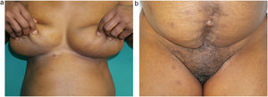 A and B, Complete disappearance of all skin lesions 3 months after administration of 3 doses of HPV vaccine.