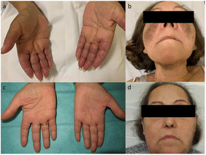 A, Erythematous, violaceous, desquamative, and symmetric plaques on the anterior surface of the fingers of both hands. B, Hyperpigmented plaques on both cheeks and in the upper cervical region. Resolution of the lesions on the hands (C) and face (D) after treatment of the underlying neoplasm.