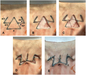 Design of the spider crab flap on pig skin. A, The 2 lateral transposition flaps, which represent the arms of the crab, are traced from the central point of the sides of the triangle. These lateral flaps measure half the length (a/2) of the base of the triangle (a), with an angle of 60° (black spots). B, Excision of the triangle representing the surgical defect and dissection of both flaps. C, Central point of suture, which starts at the base of the triangular defect and passes through the internal vertices of the lateral flaps. D, Closure of the defect with the single central stitch. E, Outcome after complete suture of the flap.