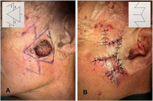 Spider crab flap. A, Design of the lateral transposition flaps at the lower left vertex of the triangle. The angles and measurements of the flap are shown in the inset (upper left). B, Outcome. Diagram showing the scar after suture (inset, upper right).