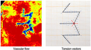 Direct correlation between the perfusion image and the tension vectors. The image on the left represents blood flow. Red indicates maximum perfusion. As blood flow diminishes, the color scale gradually degrades until it reaches blue-black, which indicates minimum perfusion. The image on the right shows the tension vectors at each suture point, such that the length of the arrows represents the magnitude of the tensions. The central vector highlighted with 3 red arrows is the point of maximum tension and, in the flow image on the left, corresponds exactly to the central area of minimum vascular flow shown in blue-black. The silhouette of the W-plasty scar, where the tensions are focused, corresponds exactly to the image of the blue flows.