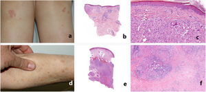 Clinical and histologic appearance of sarcoid-like reactions to immune checkpoint inhibitors. A-C, Papular sarcoidosis of the knees. The granulomas are located mainly in the superficial dermis, with frequent presence of foreign bodies. D-F, Subcutaneous sarcoidosis. The granulomas are almost limited to the subcutaneous cellular tissue and are surrounded by abundant lymphocytes and fibrosis.