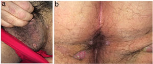 (a) Anterior view of the scrotum. (b) Posterior view of the anus and perianal area.