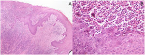 Histopathological pictures: (A) Punch biopsy of superficially ulcerated skin sample showing epidermal necrosis overlying a superficial and deep dense perivascular and periadnexal inflammatory infiltrate in the dermis. No malignant cells are seen. (Hematoxylin/eosin ×40). (B) Higher magnification highlights viral cytopathic changes, namely vacuolization of keratinocytes (ballooning), multinucleated keratinocytes with eosinophilic cytoplasm, margination of nuclear chromatin and eosinophilic internuclear inclusions (Cowdry type A). The inflammatory infiltrate is predominantly lymphocytic, with admixed plasma cells, neutrophils and scattered eosinophils. (Hematoxylin/eosin ×400).