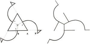 Esquema del diseño del colgajo en molinillo de viento.