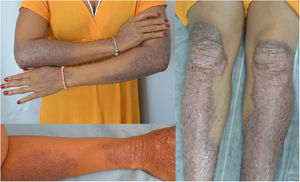 Estado basal de la paciente, presentando en zona distal de extremidades placas liquenificadas marronáceas bien delimitadas con presencia de excoriaciones.