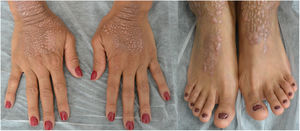 Estado basal de la paciente, con pápulas liquenificadas y excoriadas en dorso de manos y pies, y distrofia de uñas de los pies (la paciente usaba esmalte de uñas sobre los lechos ungueales).