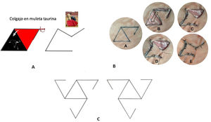 a) Colgajo en muleta taurina. b) A: Diseño del colgajo. Sobre un triángulo equilátero, dibujamos el colgajo triangular invertido que comparte uno de los lados y el otro lado, que será el pedículo, llega solo a la mitad. B: Extirpación y disección del colgajo. C: Rotación del colgajo cerrando el defecto quirúrgico primario y creando un defecto secundario más pequeño. D: Punto de ángulo para cerrar el defecto quirúrgico secundario. E: Cierre final. c) El colgajo permite 6 opciones de diseño distintas para elegir la que mejor se adapte al defecto quirúrgico periorificial.