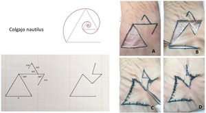 Colgajo nautilus: sobre el mismo diseño del colgajo en muleta taurina se dibuja otro triangulo superior, cuyos lados miden la mitad del colgajo inicial, que girará en sentido contrario para cerrar el defecto secundario. A: Diseño del colgajo sobre un defecto triangular. B: Rotación del colgajo cerrando el defecto quirúrgico primario. C: Cierre del defecto secundario mediante la rotación del triángulo superior. E: Cierre final.